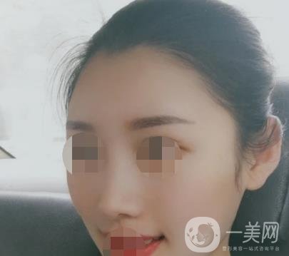 青醫(yī)附院王彥進(jìn)去痣怎么樣？?jī)r(jià)格表及*果展示