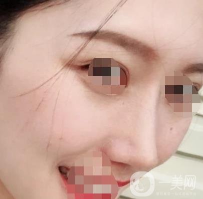 青醫(yī)附院王彥進(jìn)去痣怎么樣？?jī)r(jià)格表及*果展示