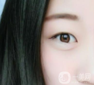 沈陽百嘉麗醫(yī)院價格表2020，附雙眼皮案例分享