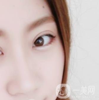 沈陽百嘉麗醫(yī)院價格表2020，附雙眼皮案例分享