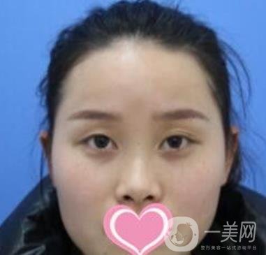 沈陽名流整形醫(yī)院價格表，附雙眼皮+隆鼻案例