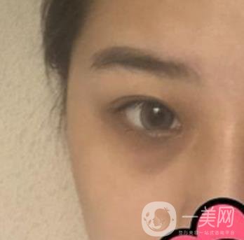 沈陽杏林整形醫(yī)院割雙眼皮*果咋樣?看實(shí)例及價格表