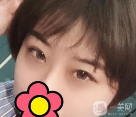 沈陽杏林整形醫(yī)院割雙眼皮*果咋樣?看實(shí)例及價格表