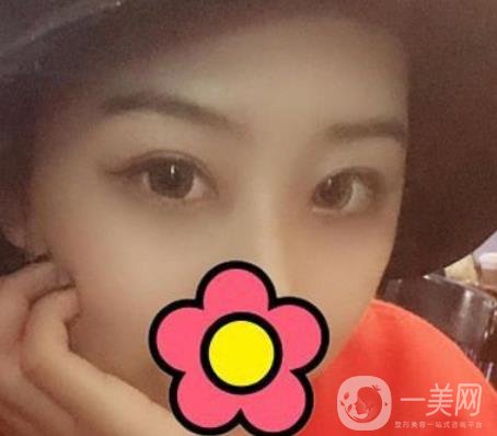 沈陽杏林整形醫(yī)院割雙眼皮*果咋樣?看實(shí)例及價格表