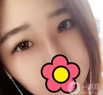 沈陽杏林整形醫(yī)院割雙眼皮*果咋樣?看實(shí)例及價格表