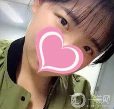 濟南中心醫(yī)院價格表，雙眼皮整形日記公布