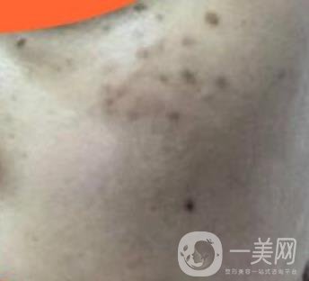 沈陽(yáng)伊美爾整形醫(yī)院價(jià)格表，附祛斑*果展示