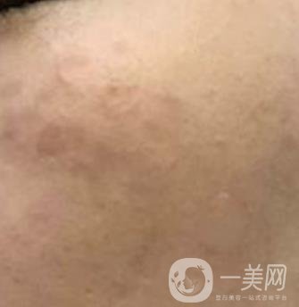 沈陽(yáng)伊美爾整形醫(yī)院價(jià)格表，附祛斑*果展示