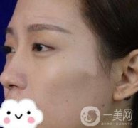 臺(tái)州博雅美惠醫(yī)療美容整形雙眼皮恢復(fù)日記，內(nèi)附價(jià)格表明細(xì)