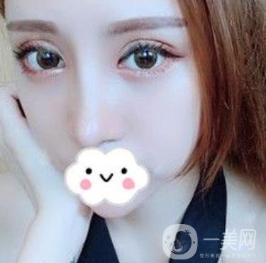 臺州博雅美惠醫(yī)療美容整形雙眼皮恢復(fù)日記，內(nèi)附價格表明細