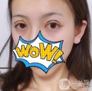 武漢艾萊美醫(yī)療整形醫(yī)院價(jià)格表項(xiàng)目收費(fèi)明細(xì)，附雙眼皮案例