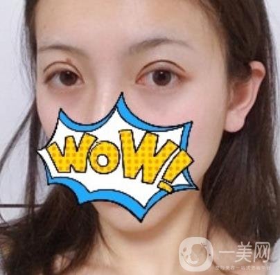 武漢艾萊美醫(yī)療整形醫(yī)院價格表項目收費明細(xì)，附雙眼皮案例