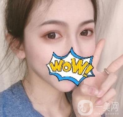 武漢艾萊美醫(yī)療整形醫(yī)院價格表項目收費明細(xì)，附雙眼皮案例