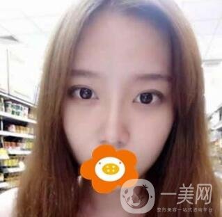 長沙鵬愛隆鼻好不好？案例&價格表