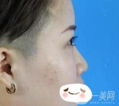 四川省人民醫(yī)院整形科駝峰鼻矯正多少錢？?jī)r(jià)格表2020更新
