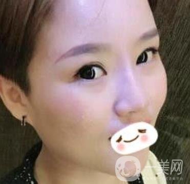 四川省人民醫(yī)院整形科駝峰鼻矯正多少錢？?jī)r(jià)格表2020更新