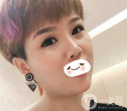 四川省人民醫(yī)院整形科駝峰鼻矯正多少錢？?jī)r(jià)格表2020更新