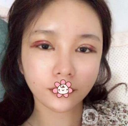 襄陽中心醫(yī)院整形美容科價(jià)格表2020版出爐，附雙眼皮日記