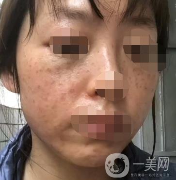 岳陽市一人民醫(yī)院整形美容科價格表及祛斑案例發(fā)布