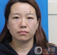 廣州壹加壹整形醫(yī)院做雙眼皮咋樣?案例+價(jià)格表詳覽