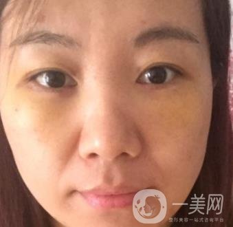 廣州壹加壹整形醫(yī)院做雙眼皮咋樣?案例+價(jià)格表詳覽