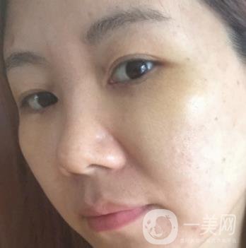 廣州壹加壹整形醫(yī)院做雙眼皮咋樣?案例+價(jià)格表詳覽