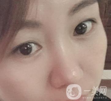 廣州壹加壹整形醫(yī)院做雙眼皮咋樣?案例+價(jià)格表詳覽