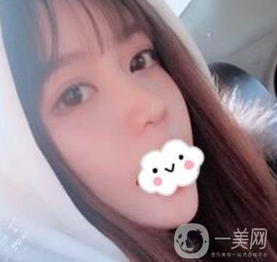 合肥中山醫(yī)院整形科價(jià)格表2020，附雙眼皮恢復(fù)*果
