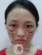 徐州亞韓整形醫(yī)院價(jià)格表費(fèi)用明細(xì)，附面部除皺日記展示
