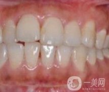 武漢大學(xué)口腔醫(yī)院牙齒矯正多少錢?果好嗎?價(jià)格費(fèi)用明細(xì)一覽