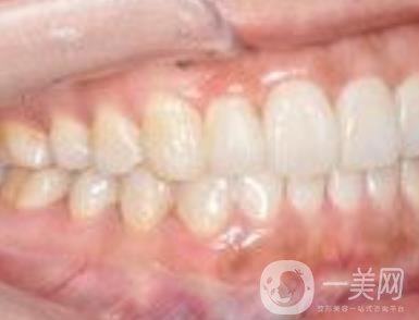 武漢大學口腔醫(yī)院牙齒矯正多少錢?*果好嗎?價格費用明細一覽
