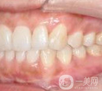 武漢大學口腔醫(yī)院牙齒矯正多少錢?*果好嗎?價格費用明細一覽