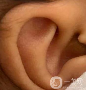 中國(guó)醫(yī)學(xué)科學(xué)院整形外科醫(yī)院外耳再造技術(shù)如何?*果好嗎?價(jià)格表收費(fèi)標(biāo)準(zhǔn)一覽