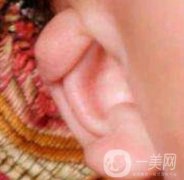 中國(guó)醫(yī)學(xué)科學(xué)院整形外科醫(yī)院外耳再造技術(shù)如何?果好嗎?價(jià)格表收費(fèi)標(biāo)準(zhǔn)一覽