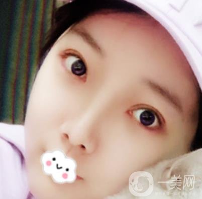 無錫二院雙眼皮做得好的醫(yī)生?附2020整形價格表及案例