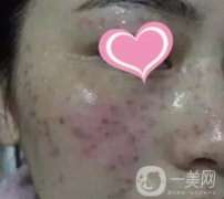 徐州二院激光祛斑怎么樣？案例及2020整形價(jià)格表一覽