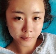 重醫(yī)附一院祛痣多少錢一顆？2020整形價(jià)格表及案例果圖分享