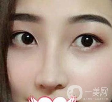 交大一附院王瑞做鼻子怎么樣？價格表及術(shù)后*果分享