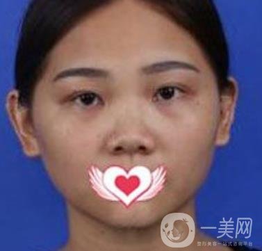 交大一附院王瑞做鼻子怎么樣？價格表及術(shù)后*果分享