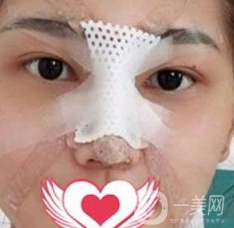 交大一附院王瑞做鼻子怎么樣？價格表及術(shù)后*果分享