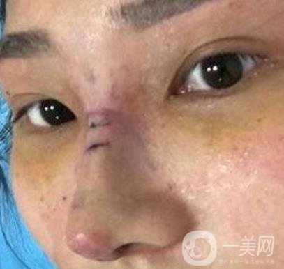交大一附院王瑞做鼻子怎么樣？價格表及術(shù)后*果分享