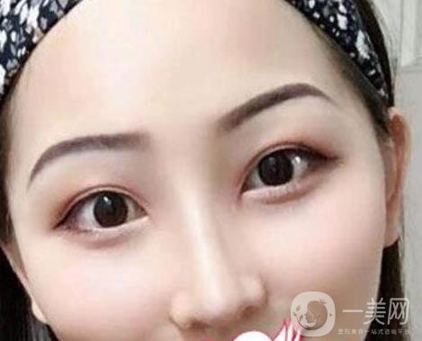 交大一附院王瑞做鼻子怎么樣？價格表及術(shù)后*果分享