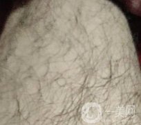 合肥華美整形醫(yī)院價(jià)格表，附脫毛案例