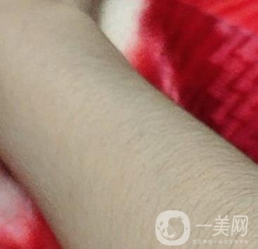 合肥華美整形醫(yī)院價格表，附脫毛案例