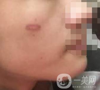 徐州第一人民醫(yī)院整形科價(jià)格表，含激光祛疤*果