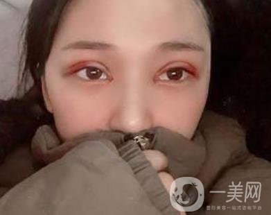 恩施州中心醫(yī)院美容整形科怎么樣？價(jià)格表和雙眼皮整形經(jīng)歷分享