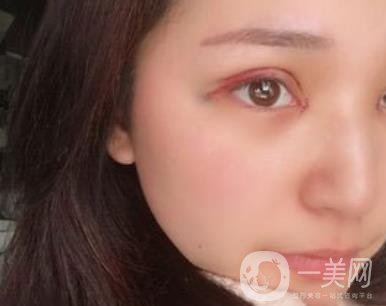 恩施州中心醫(yī)院美容整形科怎么樣？價(jià)格表和雙眼皮整形經(jīng)歷分享