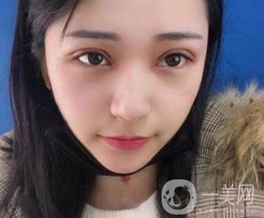 恩施州中心醫(yī)院美容整形科怎么樣？價(jià)格表和雙眼皮整形經(jīng)歷分享