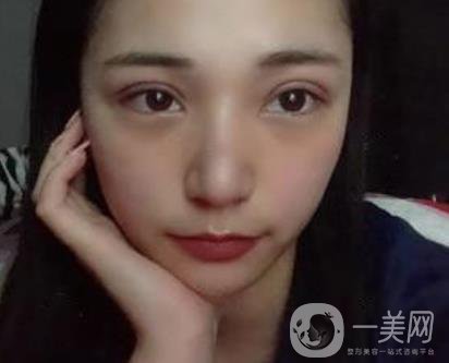 恩施州中心醫(yī)院美容整形科怎么樣？價(jià)格表和雙眼皮整形經(jīng)歷分享