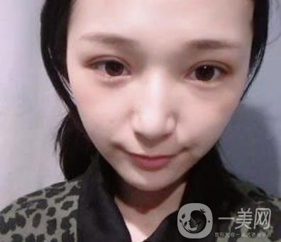 恩施州中心醫(yī)院美容整形科怎么樣？價(jià)格表和雙眼皮整形經(jīng)歷分享